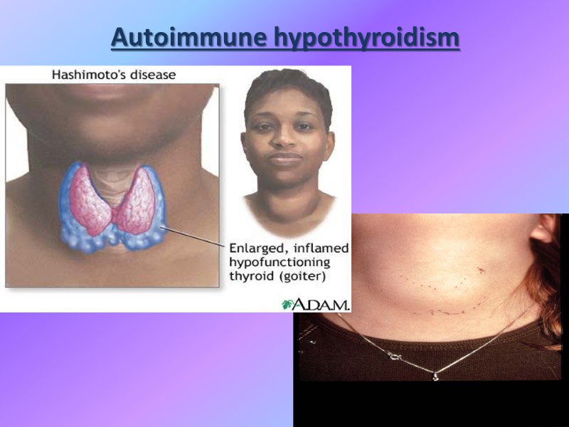 Autoimmune hypothyroidism
